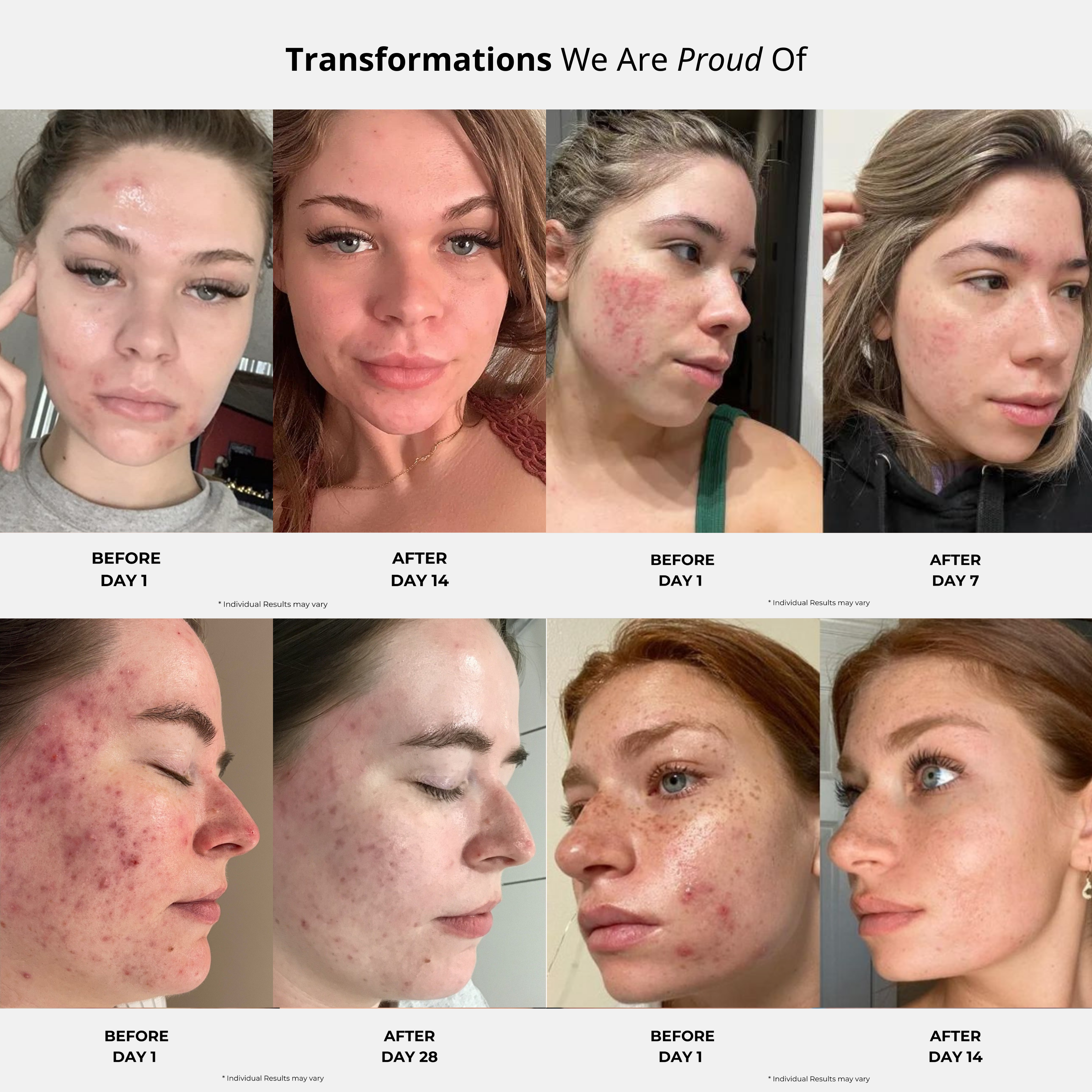 FACIAL ACNE TRANSFORMATION KIT.